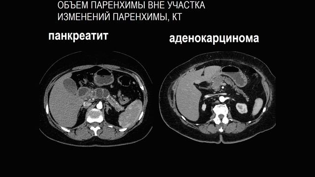 Рак поджелудочной железы Часть 2 смотреть онлайн