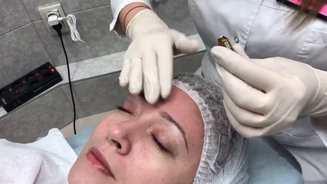 Микронидлинг на аппарате дермапен Mesodevice