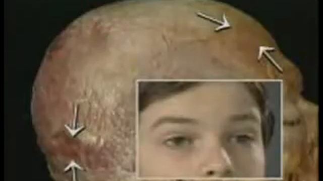 Мышцы свода черепа (из видеоатласа Окланда). смотреть онлайн