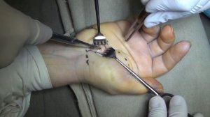 Декомпрессия срединного нерва на уровне карпального канала / Carpal tunnel release (CTR)