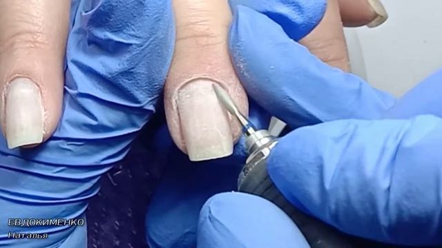 ОНИХОЛИЗИС/зачистка ногтя и протезирование полигелем