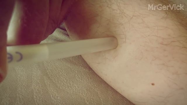 УДАЛЕНИЕ КЛЕЩА ШПРИЦОМ смотреть онлайн