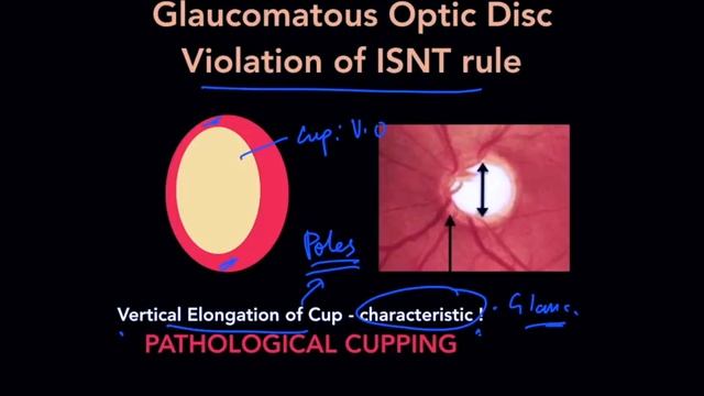 High Yield Topic : Optic Disc Changes in Glaucoma - The Complete Course смотреть онлайн
