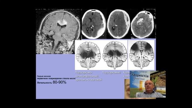 Черепно-мозговая травма