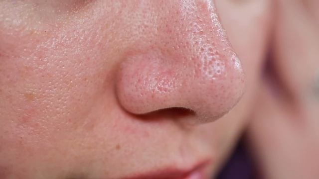 We Try Dermasuction For Our Acne смотреть онлайн