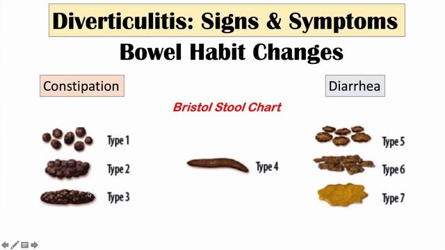 Diverticulitis Signs & Symptoms (And Why They Occur) смотреть онлайн