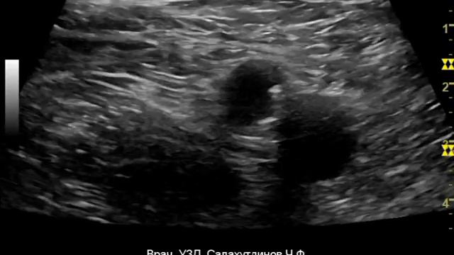 Формирование сафено-феморального соустья в "бедренном артериальном пинцете" смотреть онлайн