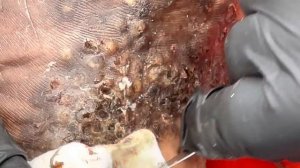 Moses's heavily jiggered left foot (part C) - watch FULL VIDEO @riseupsociety.net