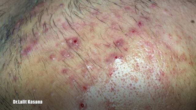 PIMPLE POPPING PART 2 смотреть онлайн