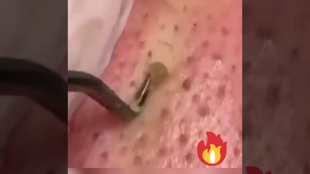 Давим жирные прыщи.