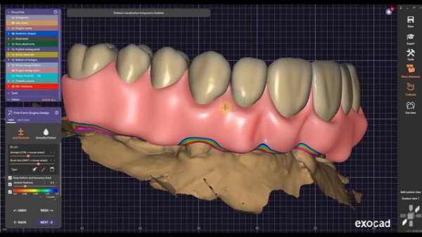 ExoCad -  ALL ON 4 Digital Workflow Thimble Crowns & Optisplint [ Screw Retained All On X ]