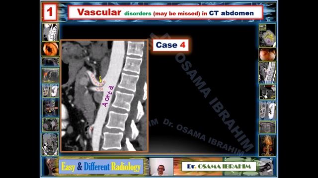 Radiology in GIT : 1- Vascular disorders (may be missed) in CT abdomen смотреть онлайн