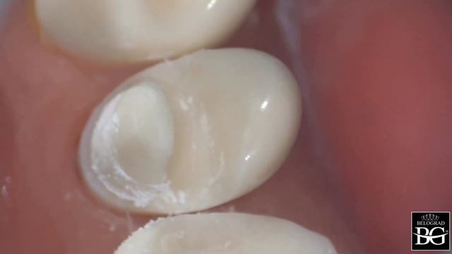 Veneer onlay prep. Finishing. Препарирование под винир-накладку смотреть онлайн