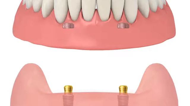 2D Manual Overdenture System смотреть онлайн