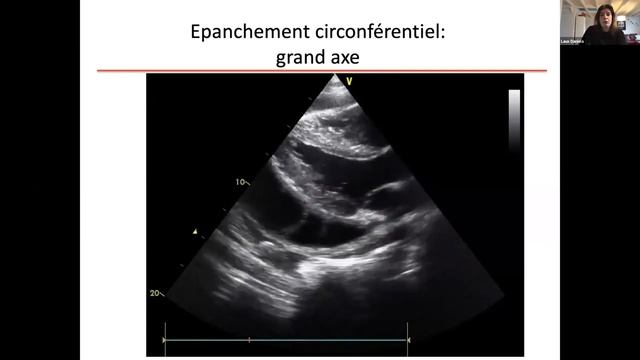 DU CPC Université de Paris Tumeurs cardiaques Pathologies du péricarde et de l'endocarde Dan смотреть онлайн