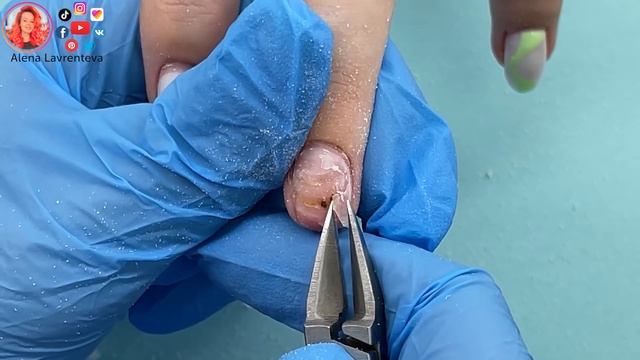 Восстановление ногтя после травмы смотреть онлайн