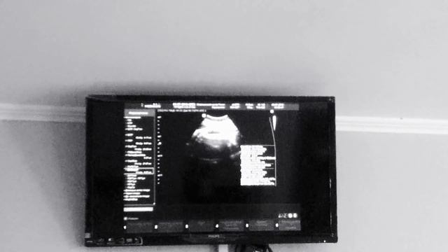 Узи 32 недели (третий скрининг с допплером) смотреть онлайн