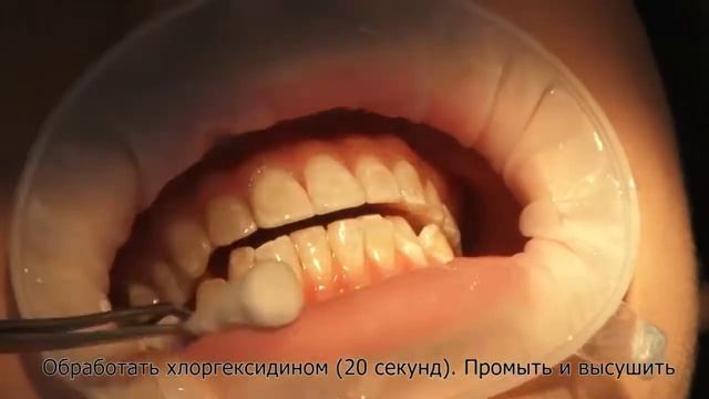 Восстановление эмали смотреть онлайн