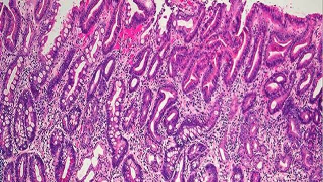 GIT PATHOLOGY LECTURE 6 - DR. SAAD MAROOF SAEED смотреть онлайн