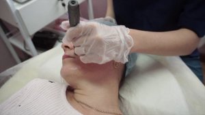Фракционная Мезотерапия Лица
