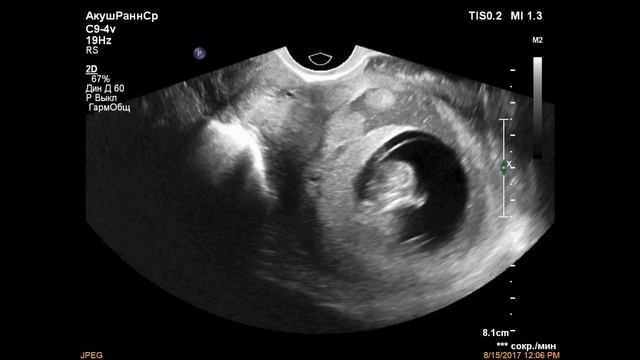 Субхориальная гематома смотреть онлайн