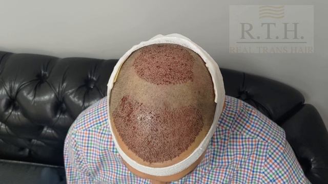 Пересадка волос. ДО и ПОСЛЕ! смотреть онлайн