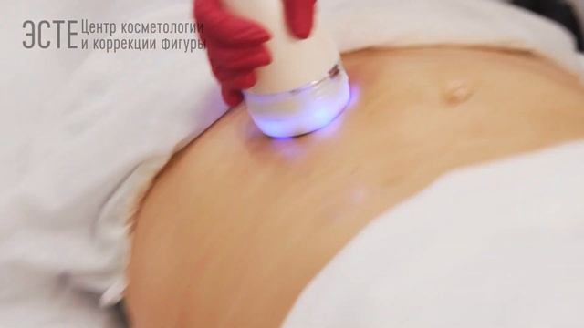 Коррекция фигуры аппаратом Resolady