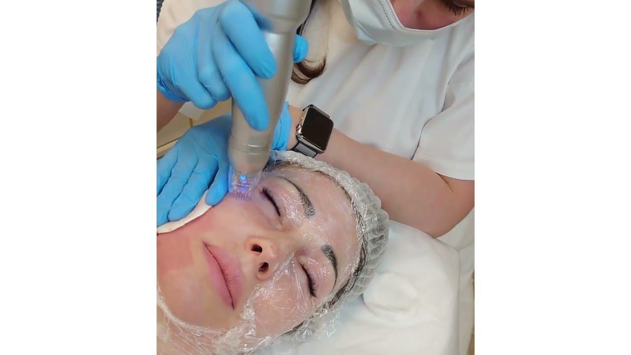 Игольчатый RF лифтинг на аппарате Scarlet смотреть онлайн