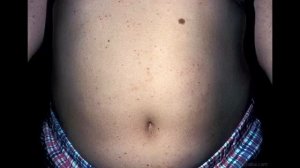 Как выглядит чесотка