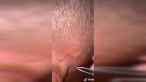 подборка выдавливания прыщей 15 II выдавливание прыща