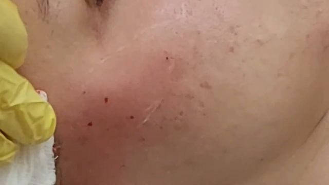 Заполнение скуловой области филлером для придания объема. смотреть онлайн