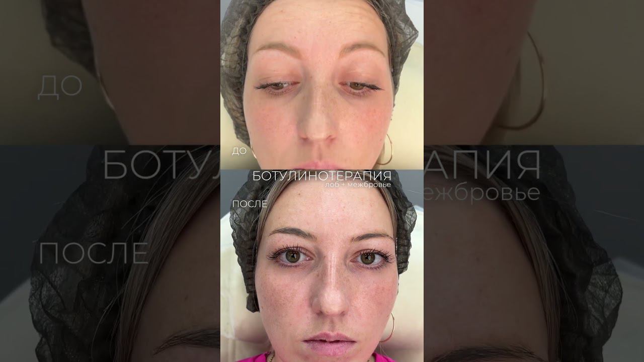 Гладкий лоб без морщин, но с сохранением мимики Red Clinic косметология #косметолог #ботокс