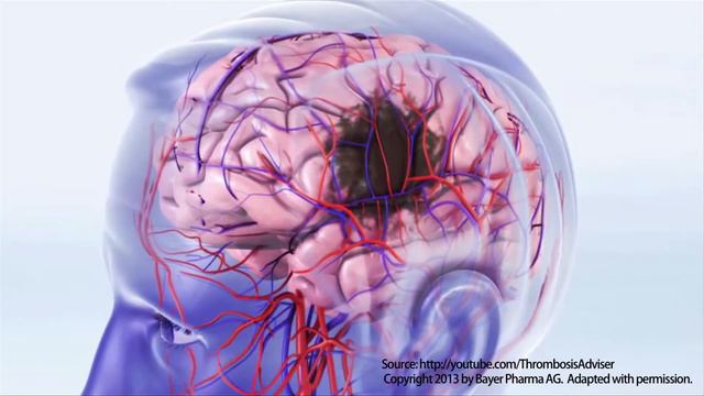 AFIB Video смотреть онлайн
