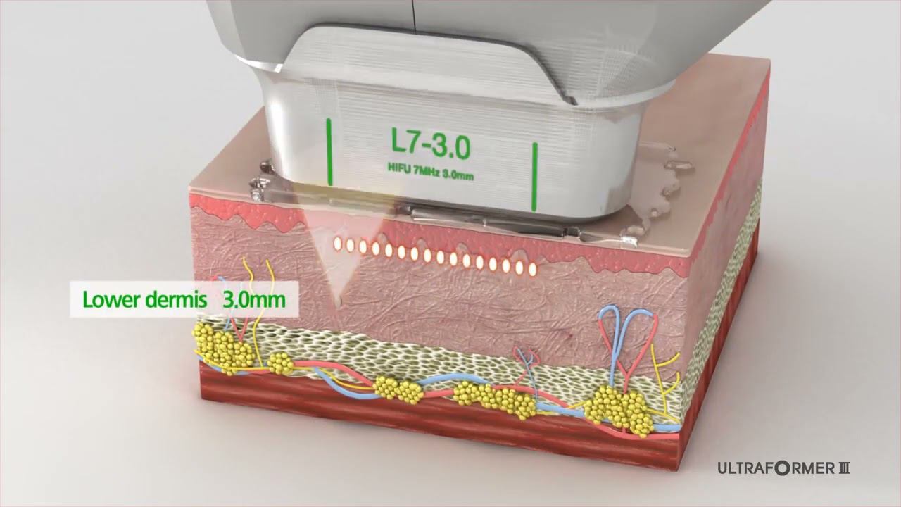 CLASSYS ULTRAFORMER III 3