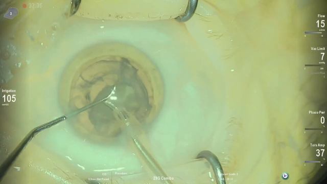 Posterior sub capsular cataract Anton Angelov Vista Live Stream смотреть онлайн