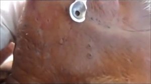 Выдавливание черных точек, угрей на носу/Nose Blackheads Squeezing
