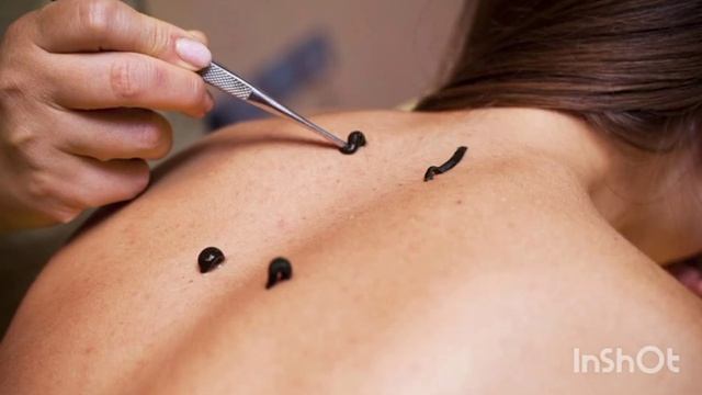 КАКИЕ ЗАБОЛЕВАНИЯ ЛЕЧАТ МЕДИЦИНСКИЕ ПИЯВКИ? смотреть онлайн