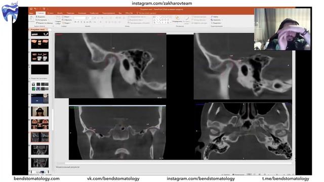 Вебинар. Дисфункции ВНЧС. Разбор клинического случая. Тимур Захаров. Гнатология. Ортопедия