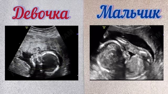 Узи мальчика и узи девочки, на 1,2 и 3 скрининге. На каком сроке лучше смотреть пол ребенка. смотреть онлайн
