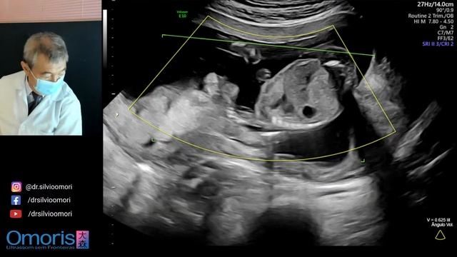 MENINO OU MENINA ? Gravidez 17  Semanas.