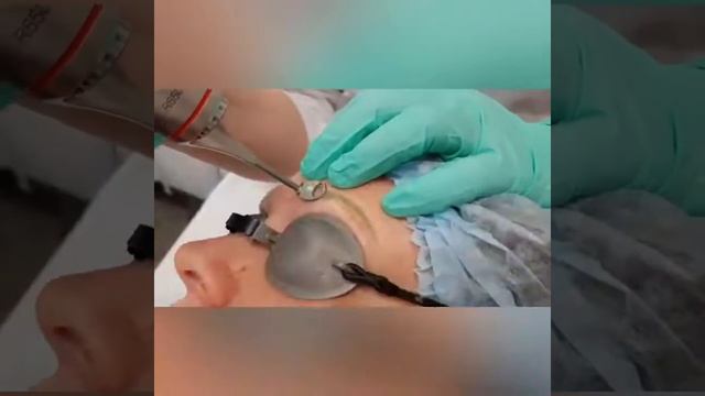 Удаление перманентного макияжа бровей в Эстетик Клуб смотреть онлайн