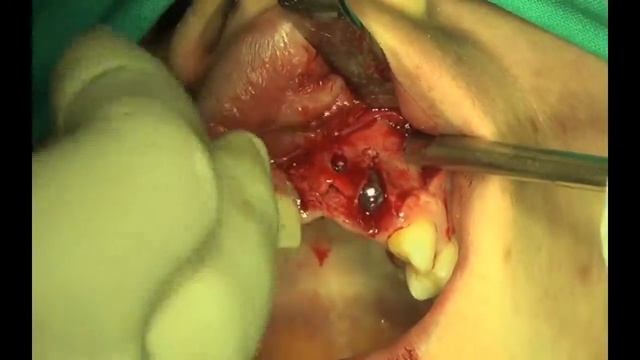 Pedicle Connective Tissue palatal Flap Anterorly Based, Insertion of NobelReplace Groovy Implant смотреть онлайн