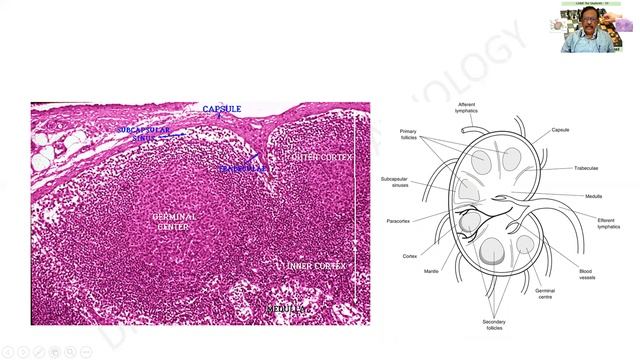 Lymph node Metastasis | GAME 19 | Dr G Shivashekar | Pathology practical Slides & Specimens | SRM смотреть онлайн