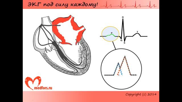 Урок 8  Видеокурс 'ЭКГ