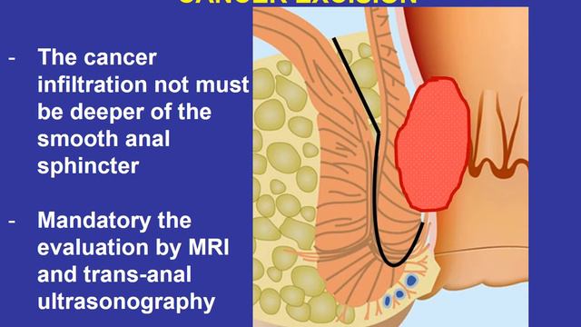 Transanal assisted ARR and new proposal in the treatment of ultralow rect cancer. смотреть онлайн