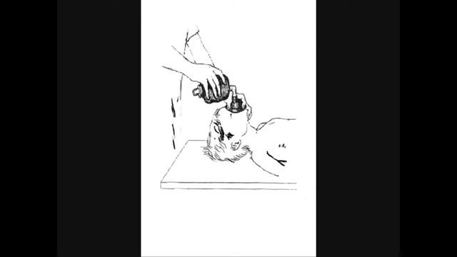 Cердечно легочная реанимация на догоспитальном этапе