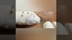 Давить прыщи, жирные прыщи и угри. Кайф!!!