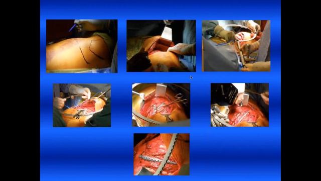 ACUTE Innovations' Peer-To-Peer Webinar: The Pitfalls of Rib Plating смотреть онлайн