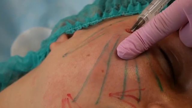 Как работает B NRG DERM PLLA 200mg