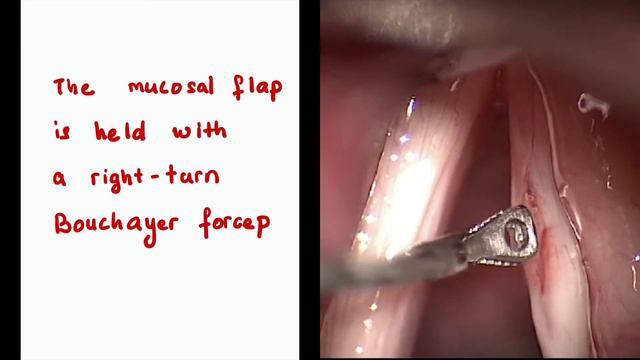VF cyst: For Phonosurgery course by Prof Marina смотреть онлайн